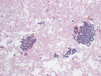 Primary Effusion Lymphoma-H&E