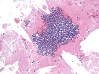 Primary Effusion Lymphoma-H&E Low Power