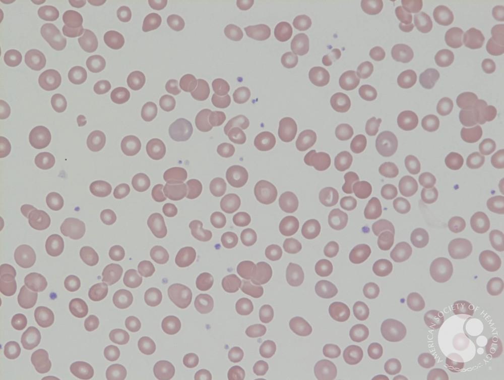 what is aplastic anemia