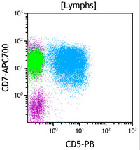 Chronic Lymphoproliferative Disorder of NK Cells - Flow Plots