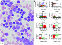 Mixed-phenotype acute leukemia with t(4;11)(q21;q23) KMT2A-AFF1–rearranged