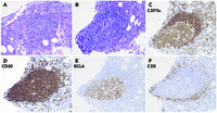 Reactive germinal centers in the bone marrow of an infant with autoimmune neutropenia