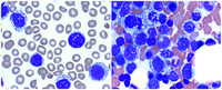 Mantle cell lymphoma with unusual Burkitt-like morphologic features