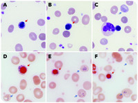 Transient appearance of ring sideroblasts in peripheral blood in the acute phase of secondary hemolytic anemia