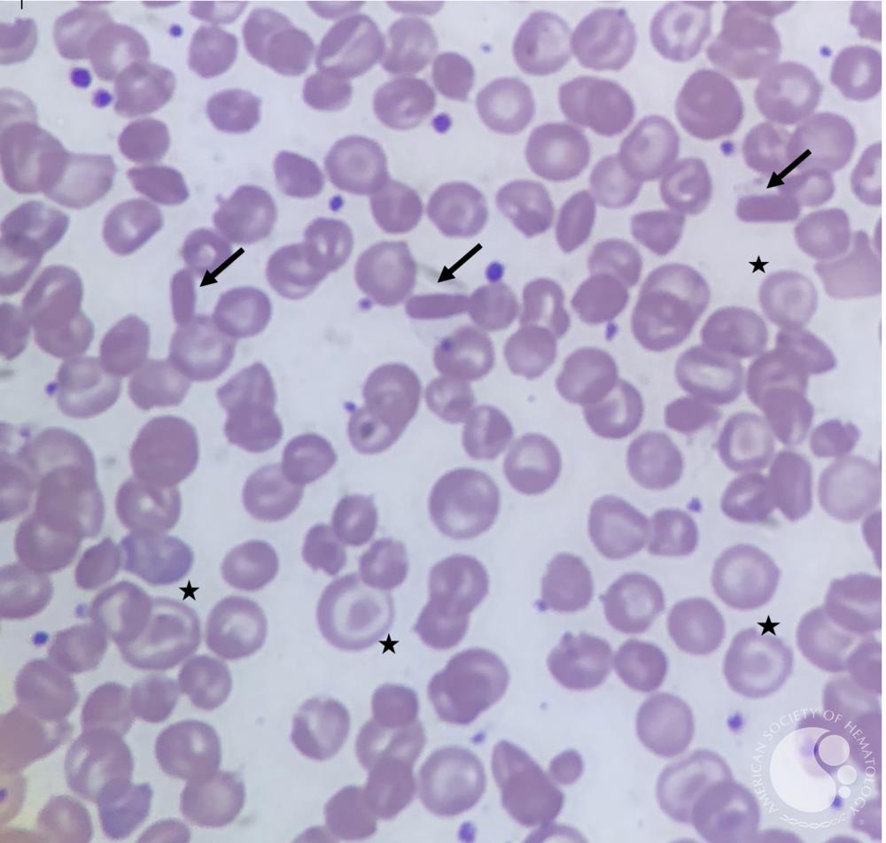 Hemoglobin C