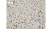 Myeloma-CD71 immunostain