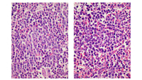 Myeloma-Marrow core biopsy H&E