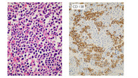 Myeloma-CD138 immunostain