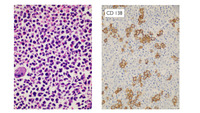 Myeloma-CD138 immunostain