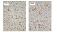 Myeloma-Light chain immunohistochemistry.