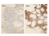 Indolent T-cell Lymphoproliferative Disorder: CD4 & CD8