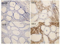 Indolent T-cell Lymphoproliferative Disorder: CD20, CD3, CD8, & CD2