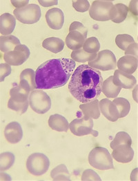 Large granular lymphocyte in a patient of systemic lupus