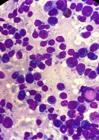 T Acute Lymphoblastic Leukemia With Plasmacytosis 1 