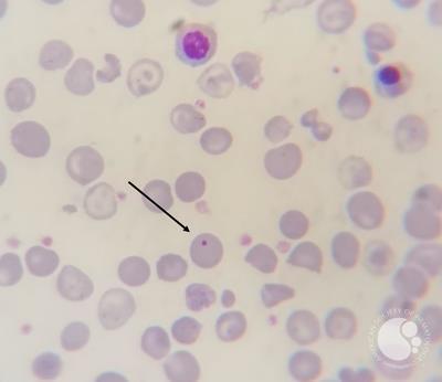 Thalassemia major case with Howell-jolly bodies and increased NRBC 1