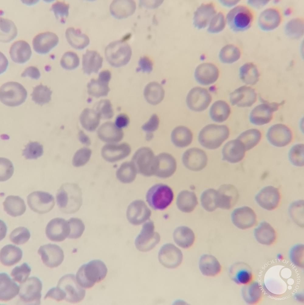 Thalassemia major case with Howell-jolly bodies and increased NRBC 2