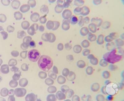 Thalassemia major case with Howell-jolly bodies and increased NRBC 3
