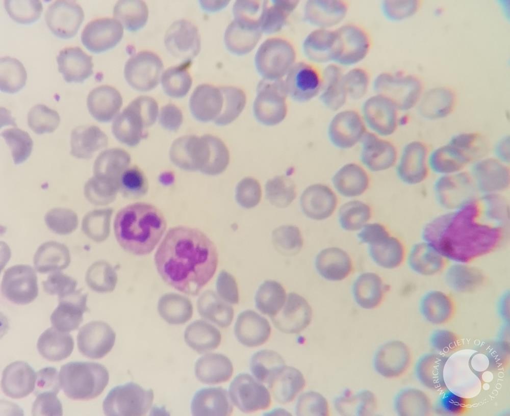 Thalassemia major case with Howell-jolly bodies and increased NRBC 3