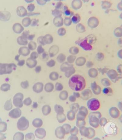 Thalassemia major case with Howell-jolly bodies and increased NRBC 4