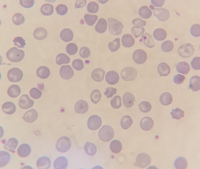 Thalassemia major case with Howell-jolly bodies and increased NRBC 5