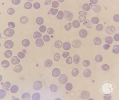Thalassemia major case with Howell-jolly bodies and increased NRBC 5