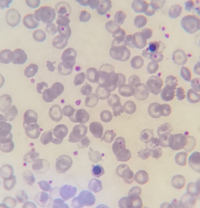 Thalassemia major case with Howell-jolly bodies and increased NRBC 6