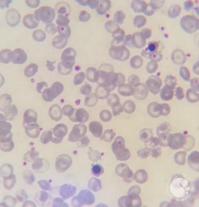 Thalassemia major case with Howell-jolly bodies and increased NRBC 6