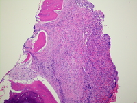 Bone marrow with mast cell infiltrate; H&E; 100X.