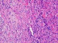 Mast cell infiltrate with dysmegakaryopoiesis; H&E stain; 400X.