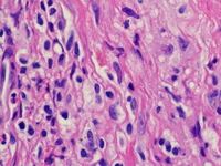 Mast cell infiltrate; H&E; 400 X Objective.
