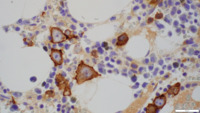 E-cadherin IHC stain