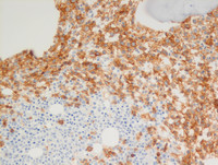 Transformed follicular lymphoma- Bone marrow-CD19