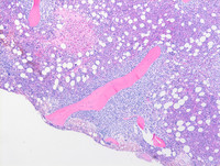 Transformed Follicular lymphoma-Bone marrow biopsy H&E