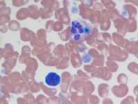 Peripheral blood smear with candida fungemia-1
