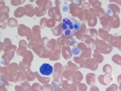 Peripheral blood smear with candida fungemia-1