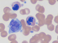 Peripheral blood smear with candida fungemia-2