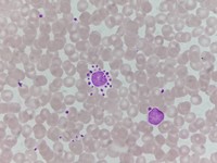 Pseudothrombocytopenia