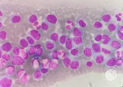 Transformed lymphocytes mimicking blasts/atypical cells