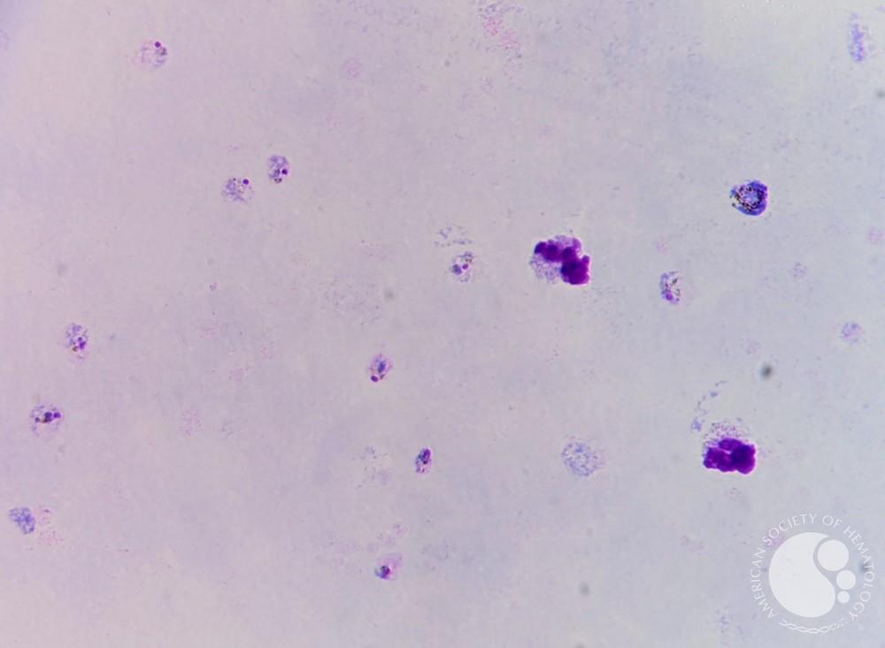 Thick smear Plasmodium vivax