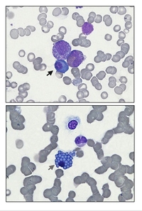 B-Prolymphocytic Leukemia