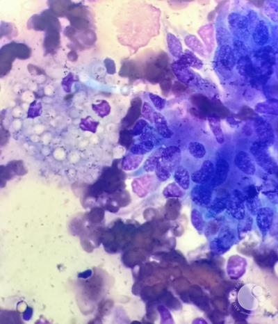 Pulmonary Cryptococcoma in an immunocompetent  patient with suspected lung malignancy  – A tumor mimicker and diagnostic challenge