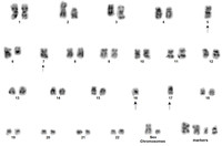 AML with myelodysplasia related changes- karyotype