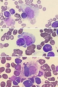 Different phases of hemophagocytosis in bone marrow (100x).