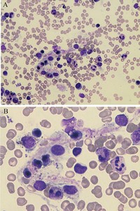 Hemophagocytosis in bone marrow (40x and 100x)