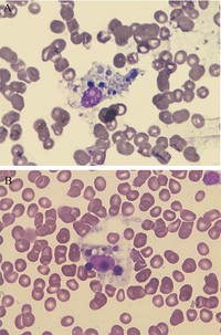 Vacuolated macrophage with digested cells, bone marrow aspirate (100x).