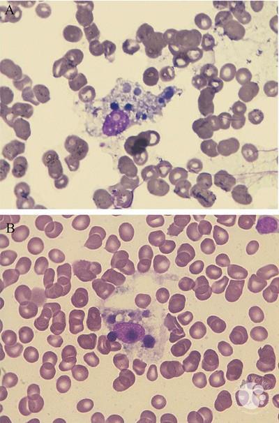 Vacuolated macrophage with digested cells, bone marrow aspirate (100x).