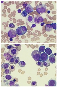Megaloblastic anemia (100x). 3
