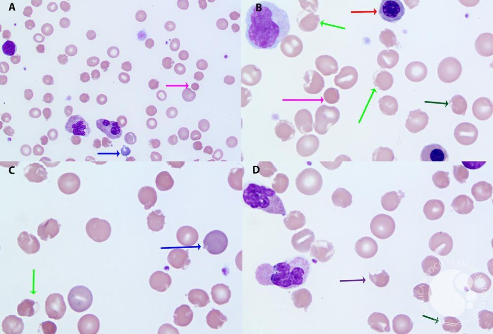 Peripheral blood smear findings in COVID coagulopathy