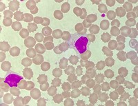 CLL with intracytoplasmic inclusions 1