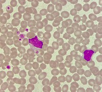 CLL with intracytoplasmic inclusions 2